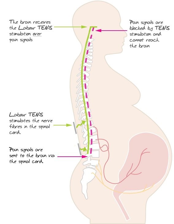 Tens for Labor Pain